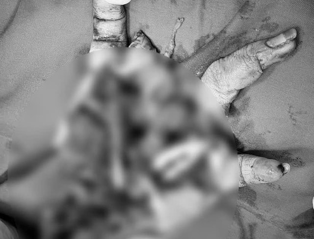 Nam sinh bị dập nát bàn tay do pháo nổ- Ảnh 1. Nam sinh bị dập nát bàn tay do pháo nổ- Ảnh 1.