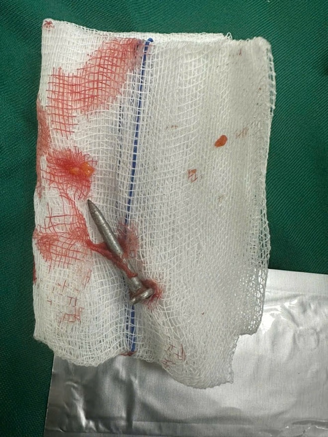 Phẫu thuật nội soi cấp cứu thành công cho nam thanh niên bị đinh xuyên thủng ruột non - Ảnh 3.