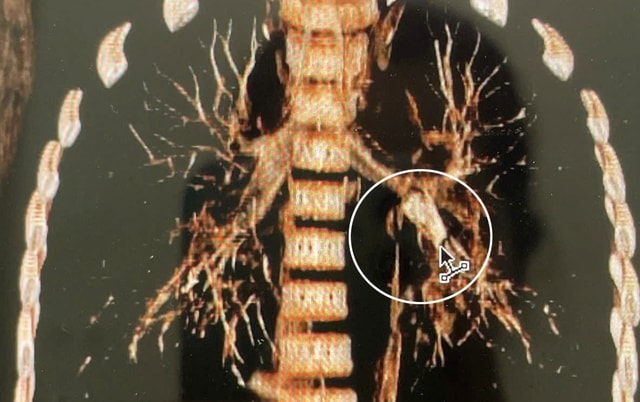 Đang ngồi học bỗng tím tái, bé trai 7 tuổi khiến bác sĩ hốt hoảng khi soi phế quản- Ảnh 1. Đang ngồi học bỗng tím tái, bé trai 7 tuổi khiến bác sĩ hốt hoảng khi soi phế quản- Ảnh 1.