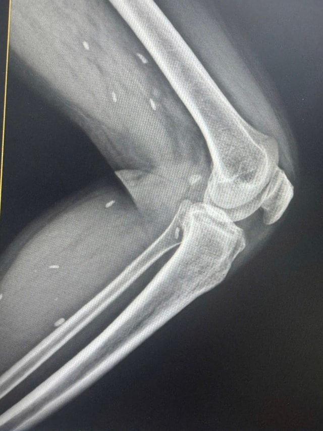 Phát hiện nhiều kén sán ở chân bệnh nhân do một thói quen thường gặp- Ảnh 1.