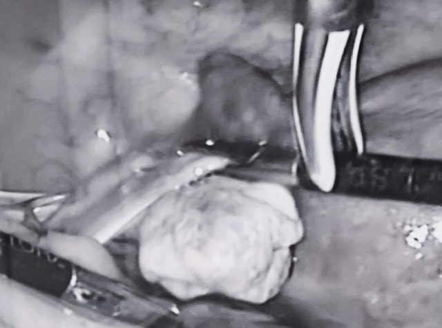 Ứng dụng dao siêu âm công nghệ cao phẫu thuật đa u xơ tử cung phức tạp- Ảnh 1. Ứng dụng dao siêu âm công nghệ cao phẫu thuật đa u xơ tử cung phức tạp- Ảnh 1.