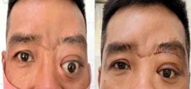 Bệnh hiếm gây lồi mắt, 20 năm Bệnh viện Tai Mũi Họng TPHCM chỉ gặp 2 ca- Ảnh 1. Bệnh hiếm gây lồi mắt, 20 năm Bệnh viện Tai Mũi Họng TPHCM chỉ gặp 2 ca- Ảnh 1.