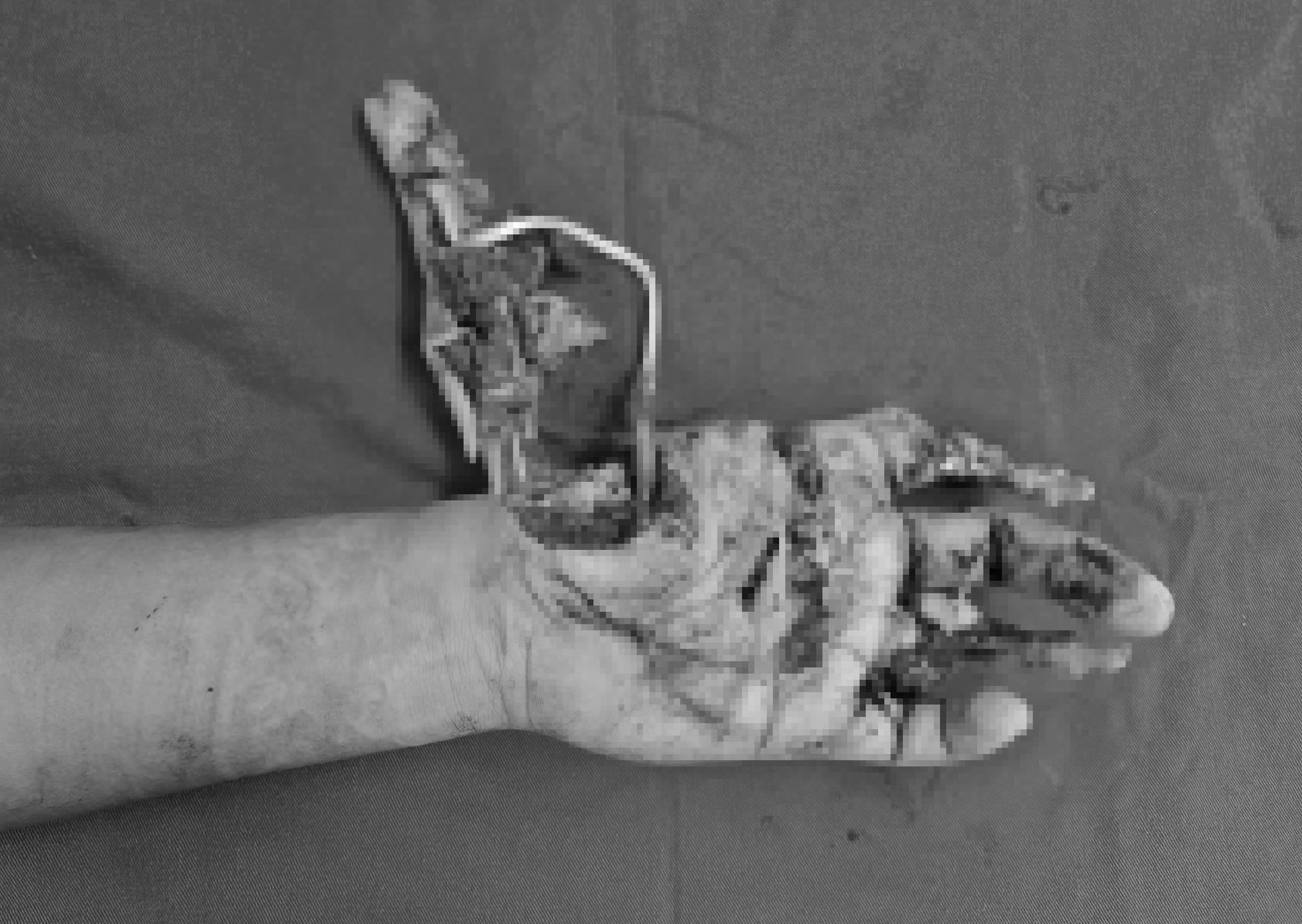 Tự chế pháo, thiếu niên 15 tuổi bị dập nát bàn tay không thể phục hồi chức năng như ban đầu - Ảnh 1.