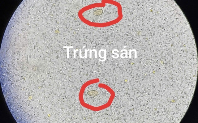 Ổ sán trong đường mật người đàn ông hay ăn đồ tái sống- Ảnh 1.