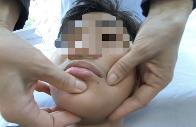 Nhiều ca nhập viện bị liệt mặt, méo miệng do rét đậm- Ảnh 2.