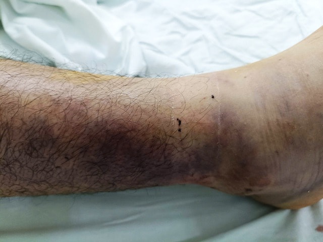 Kịp thời cứu nam thanh niên bị rắn lục xanh đuôi đỏ cắn khi đi làm rẫy- Ảnh 1.