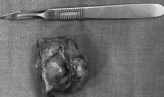 Mổ ruột thừa, bác sĩ phát hiện ung thư thận ở bệnh nhân 76 tuổi- Ảnh 2. Mổ ruột thừa, bác sĩ phát hiện ung thư thận ở bệnh nhân 76 tuổi- Ảnh 2.