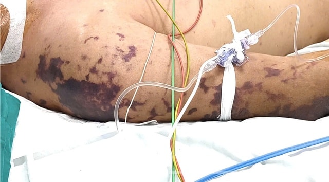 Người đàn ông khó thở, tím tái sau 2 ngày ăn cỗ- Ảnh 2. Người đàn ông khó thở, tím tái sau 2 ngày ăn cỗ- Ảnh 2.