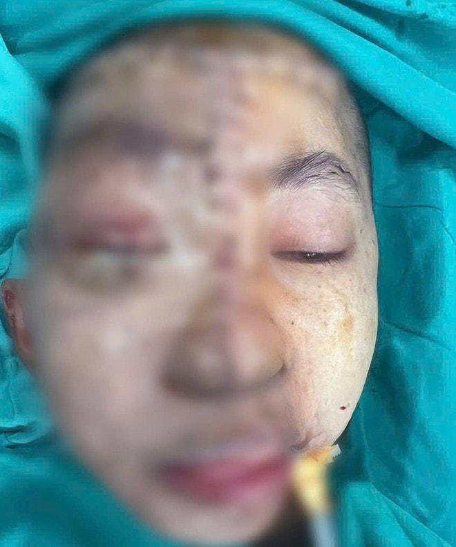 Cô gái 19 tuổi được phẫu thuật sau 17 năm mang khối u khổng lồ vùng mặt- Ảnh 2.