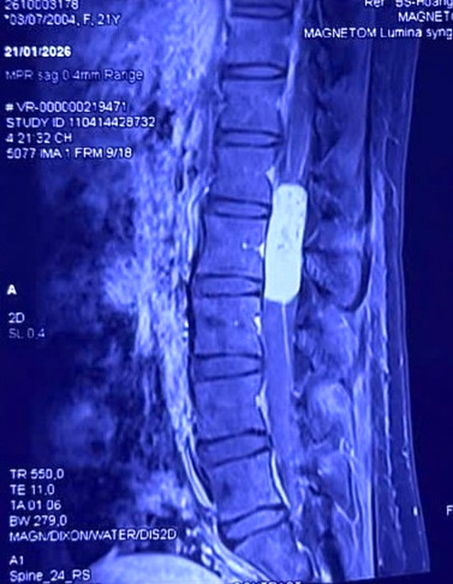 Hạnh phúc nghẹn ngào của người mẹ trẻ sau ca vi phẫu loại bỏ khối u tủy gần 10cm- Ảnh 1.