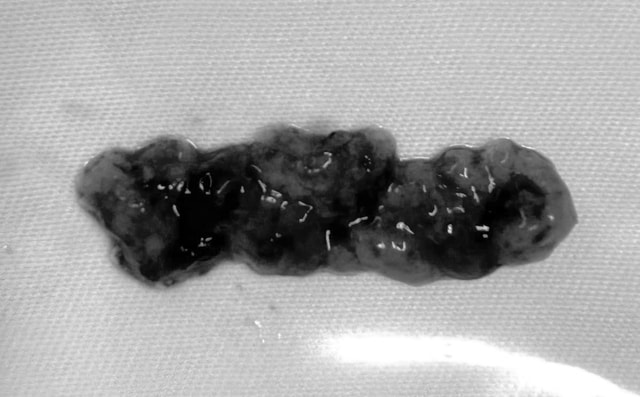 Hạnh phúc nghẹn ngào của người mẹ trẻ sau ca vi phẫu loại bỏ khối u tủy gần 10cm- Ảnh 2.