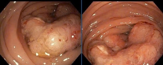 Cứu sống cụ bà 92 tuổi mắc u đại tràng kèm nhiều bệnh nền- Ảnh 2.