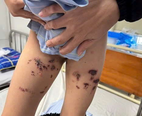 Bé trai bỏng nặng tầng sinh môn do nước tẩy tẩy bồn cầu bắn vào người- Ảnh 1. Bé trai bỏng nặng tầng sinh môn do nước tẩy tẩy bồn cầu bắn vào người- Ảnh 1.