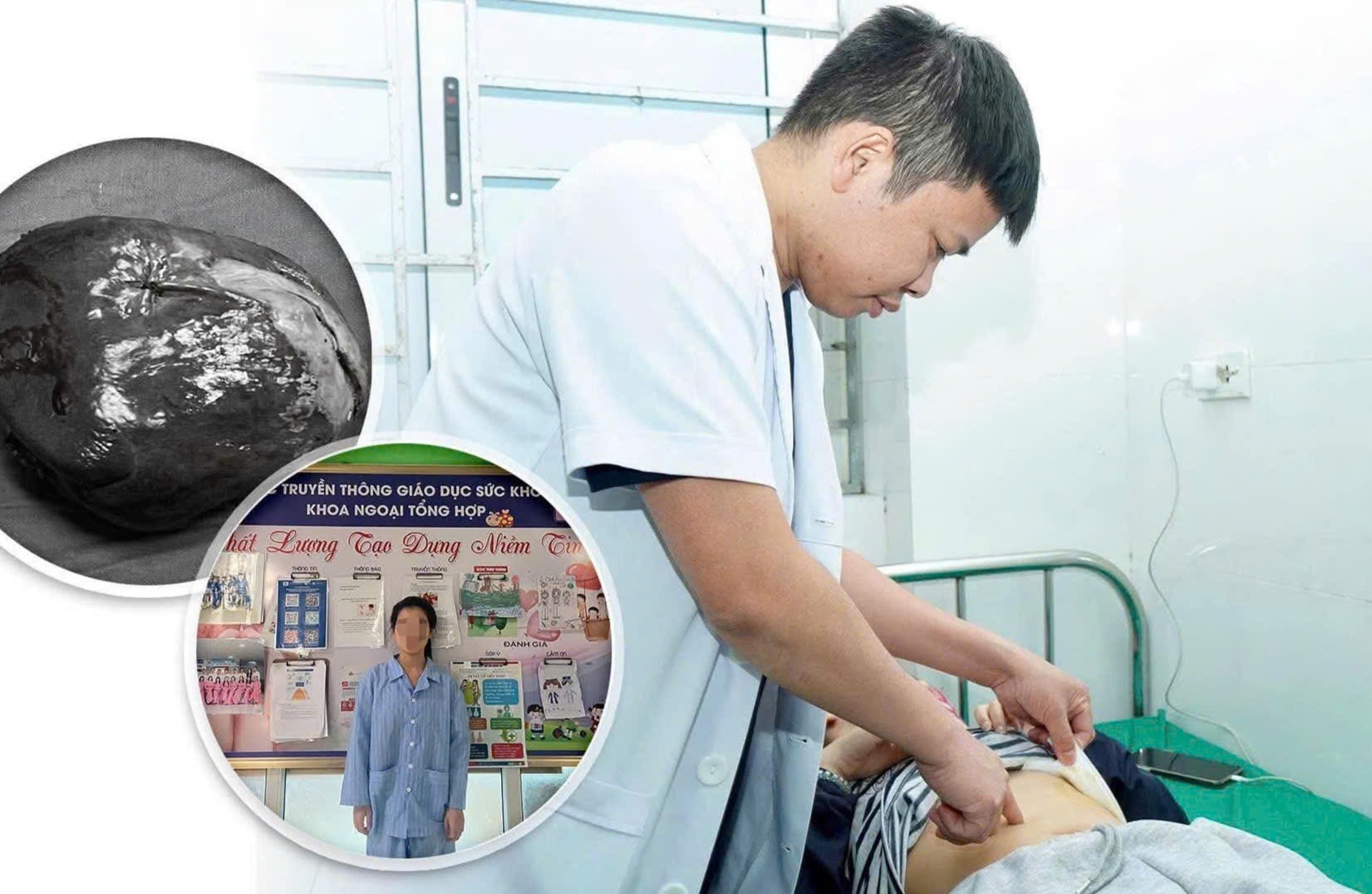 Phẫu thuật cắt lách bán phần điều trị u nang lách khổng lồ- Ảnh 1.