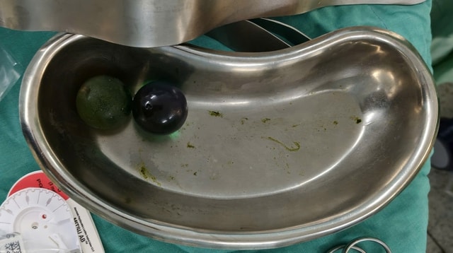 Nhiều trẻ nhỏ bị tắc ruột do nuốt hạt nở đồ chơi- Ảnh 2. Nhiều trẻ nhỏ bị tắc ruột do nuốt hạt nở đồ chơi- Ảnh 2.