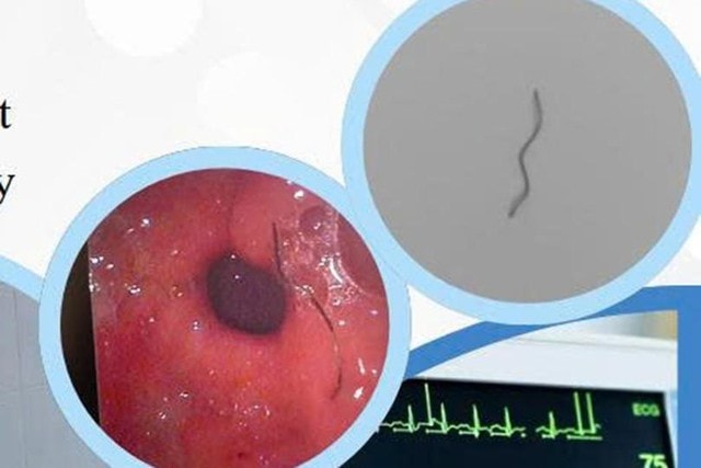 Gắp thành công sợi thép xuyên thành dạ dày bệnh nhân- Ảnh 2.