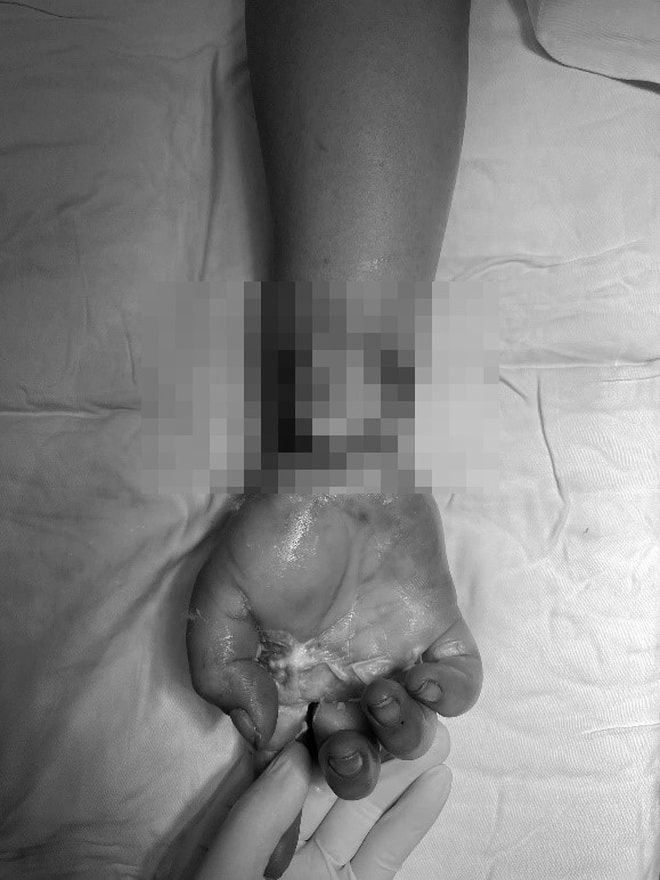 Dựng cây nêu vướng dây điện, người phụ nữ nguy cơ mất cẳng tay- Ảnh 2.