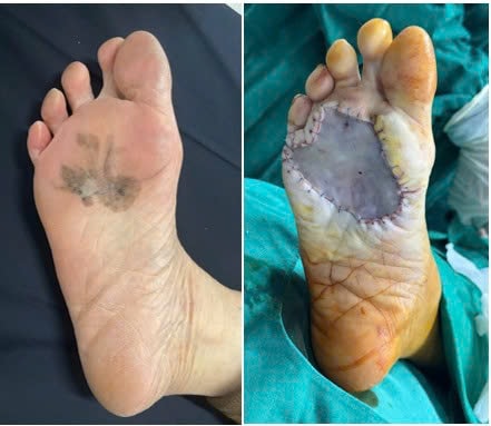 Vết đen ở bàn chân suốt 15 năm mới phát hiện ung thư- Ảnh 1.