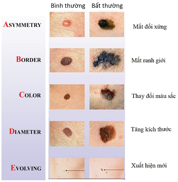 Vết đen ở bàn chân suốt 15 năm mới phát hiện ung thư- Ảnh 2.