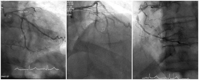 Can thiệp kịp thời cứu cụ ông 86 tuổi sốc tim nguy kịch- Ảnh 1. Can thiệp kịp thời cứu cụ ông 86 tuổi sốc tim nguy kịch- Ảnh 1.