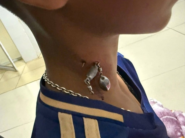 Móc câu cắm sâu vào cổ cậu bé- Ảnh 1. Móc câu cắm sâu vào cổ cậu bé- Ảnh 1.