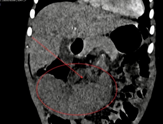 Phẫu thuật nội soi xử lý ca lách xoắn hiếm gặp ở trẻ 40 tháng tuổi- Ảnh 1. Phẫu thuật nội soi xử lý ca lách xoắn hiếm gặp ở trẻ 40 tháng tuổi- Ảnh 1.