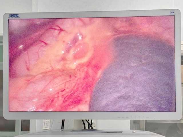 Phẫu thuật nội soi xử lý ca lách xoắn hiếm gặp ở trẻ 40 tháng tuổi- Ảnh 2. Phẫu thuật nội soi xử lý ca lách xoắn hiếm gặp ở trẻ 40 tháng tuổi- Ảnh 2.