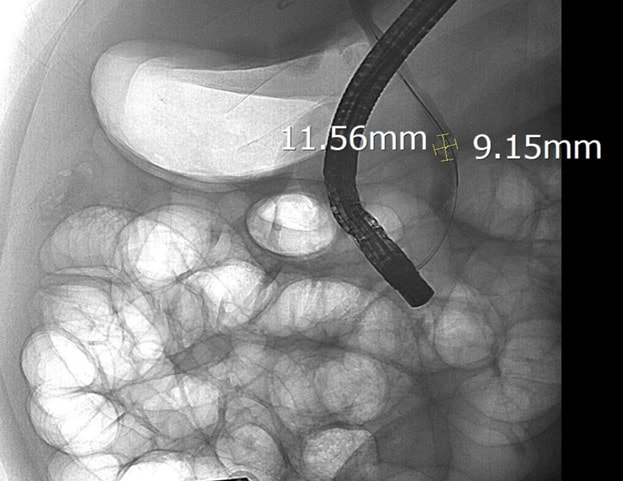 Sỏi ống mật chủ 'khủng' gây tắc mật nặng- Ảnh 2. Sỏi ống mật chủ 'khủng' gây tắc mật nặng- Ảnh 2.