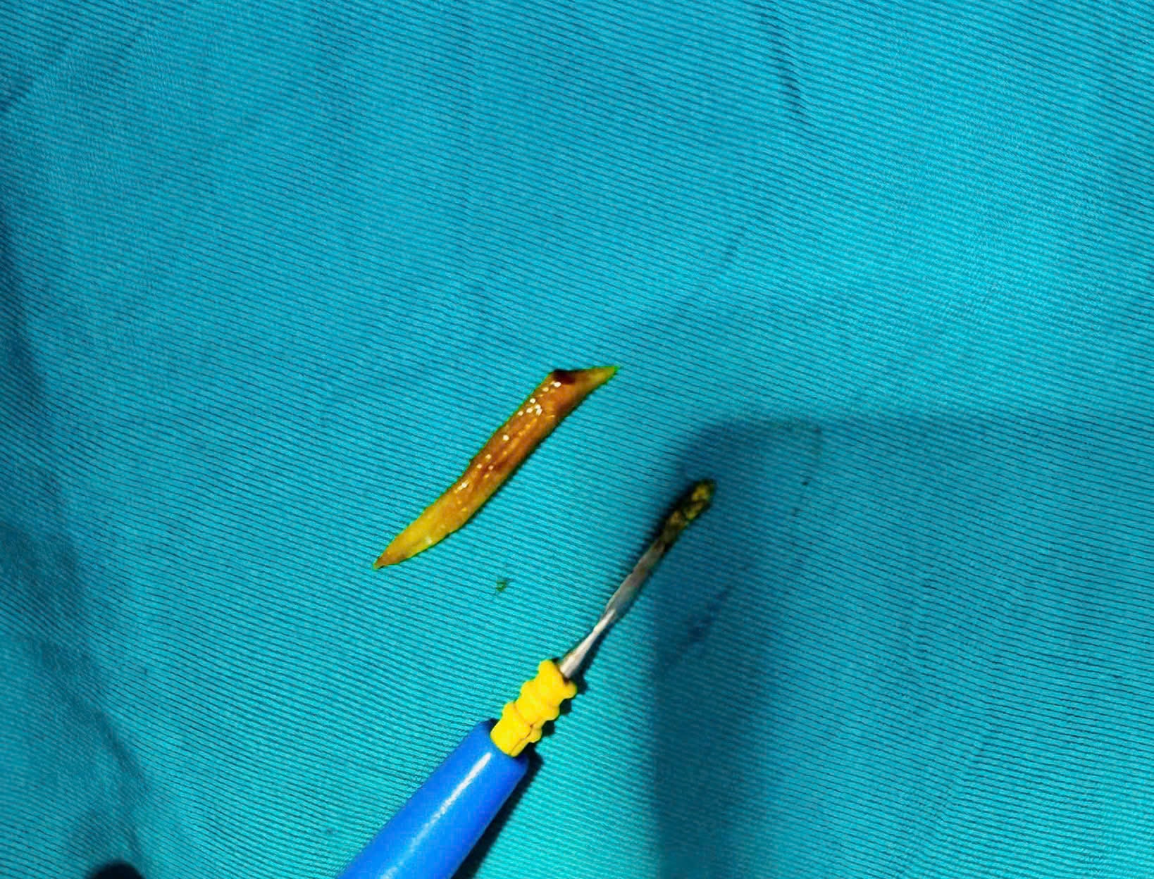 Nam bệnh nhân nhập viện cấp cứu vì xương cá kích thước lớn 'đi lạc' xuống... ruột non- Ảnh 2.