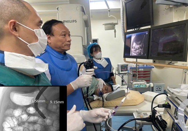 Sỏi ống mật chủ 'khủng' gây tắc mật nặng- Ảnh 3. Sỏi ống mật chủ 'khủng' gây tắc mật nặng- Ảnh 3.