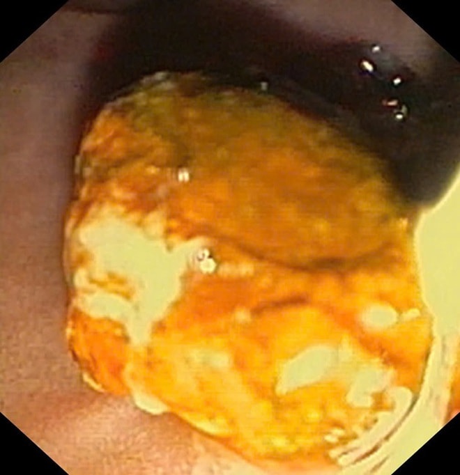 Sỏi ống mật chủ 'khủng' gây tắc mật nặng- Ảnh 4. Sỏi ống mật chủ 'khủng' gây tắc mật nặng- Ảnh 4.