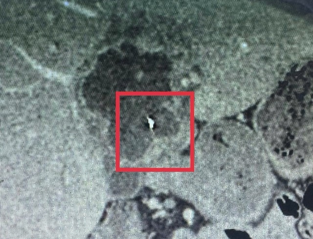 Lấy thành công kim khâu dài 6 cm nằm trong gan người đàn ông - Ảnh 1. Lấy thành công kim khâu dài 6 cm nằm trong gan người đàn ông - Ảnh 1.