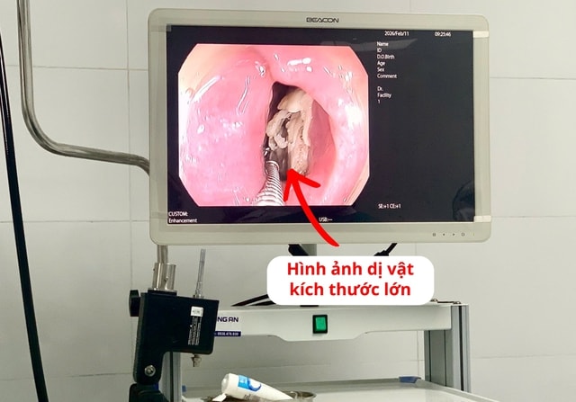 Lấy xương gà kích thước lớn mắc kẹt trong thực quản bệnh nhân- Ảnh 1.