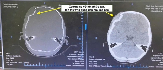 Hội chẩn liên viện trong đêm, cứu sống bệnh nhi 5 tuổi chấn thương sọ não nặng- Ảnh 2.