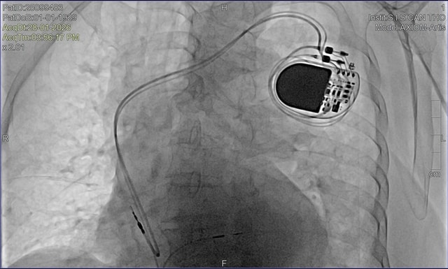 Cụ bà U100 vẫn được tiếp cận kỹ thuật tim mạch hiện đại ngay tại Tây Nam Bộ- Ảnh 1. Cụ bà U100 vẫn được tiếp cận kỹ thuật tim mạch hiện đại ngay tại Tây Nam Bộ- Ảnh 1.