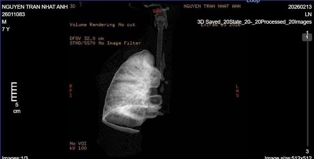 Gắp mảnh nhựa sắc nhọn, cứu bé 7 tuổi xẹp hoàn toàn phổi trái- Ảnh 2.