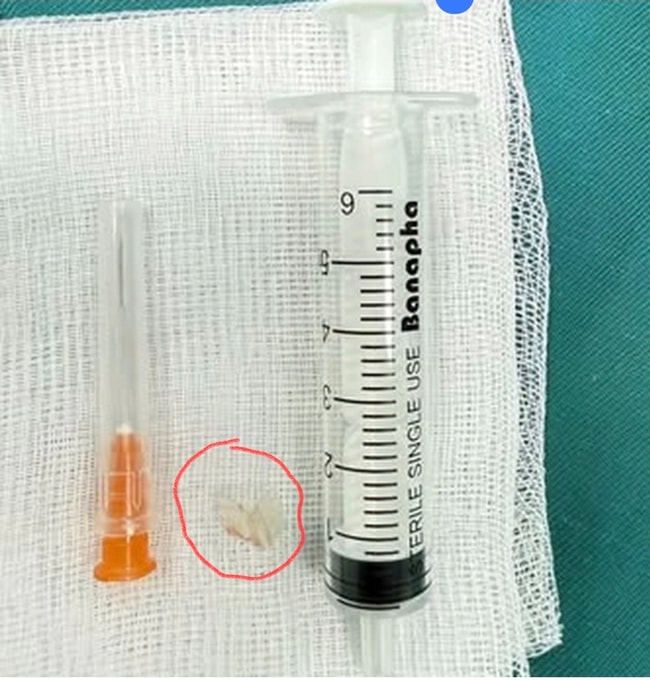 Mảnh nhựa sắc nhọn được các bác sĩ nội soi gắp ra khỏi đường thở bệnh nhi.