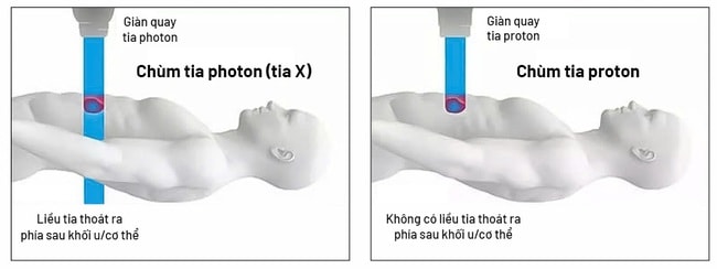 Xạ trị photon (tia X) đưa liều xạ vào khối u nhưng vẫn có thể “đi xuyên qua” phía sau, có thể gây tổn thương mô lành quanh đường đi của tia; trong khi đó xạ trị proton hiện đại với tia năng lượng biết “dừng đúng chỗ” ngay vị trí khối u để tiêu diệt khối u hiệu quả và an toàn cao.