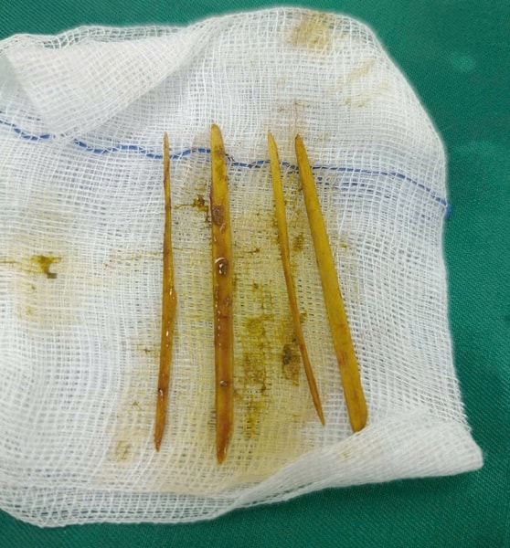 Bất ngờ, cô gái 26 tuổi nuốt 3 que tăm trong cỗ cưới - Ảnh 2.