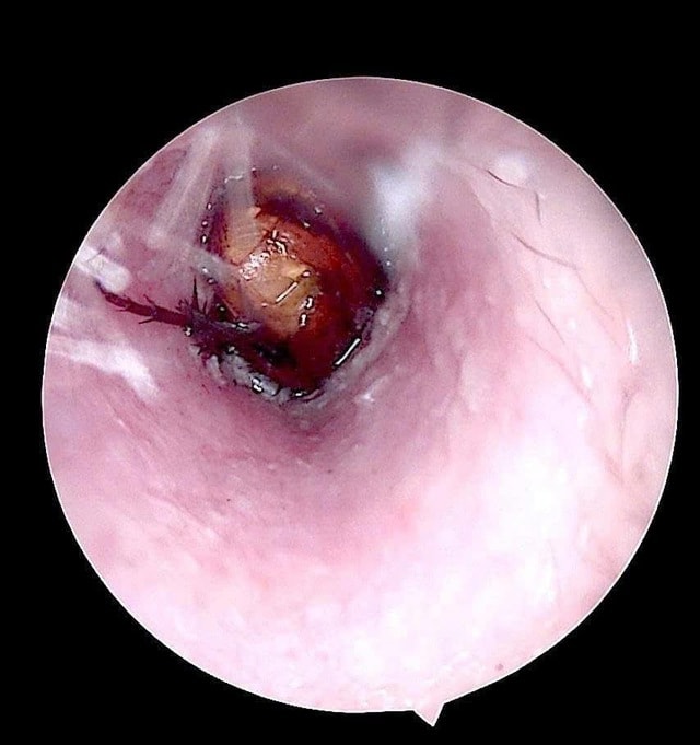 Nhờ tiệm cắt tóc lấy dị vật, bệnh nhân bị xung huyết ống tai- Ảnh 1.