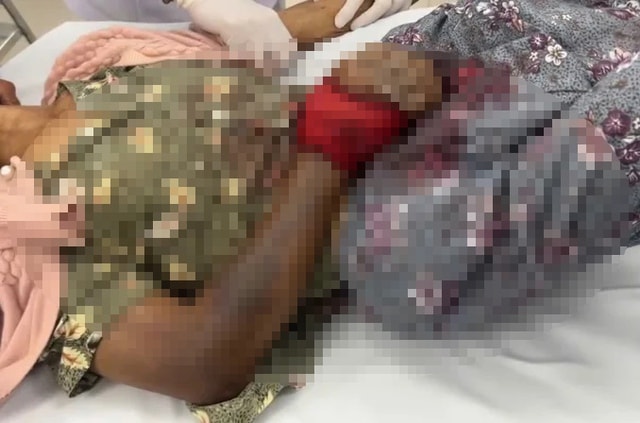 Tự chữa sau khi bị rắn độc cắn, một phụ nữ ở Lâm Đồng nguy kịch- Ảnh 1.