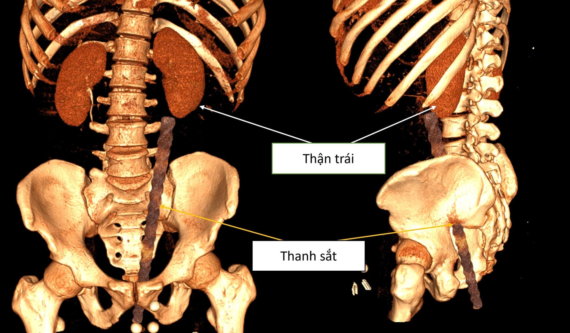 Tai nạn hi hữu: Nam thanh niên bị cọc sắt xuyên qua hậu môn sau cú ngã ngồi- Ảnh 1.