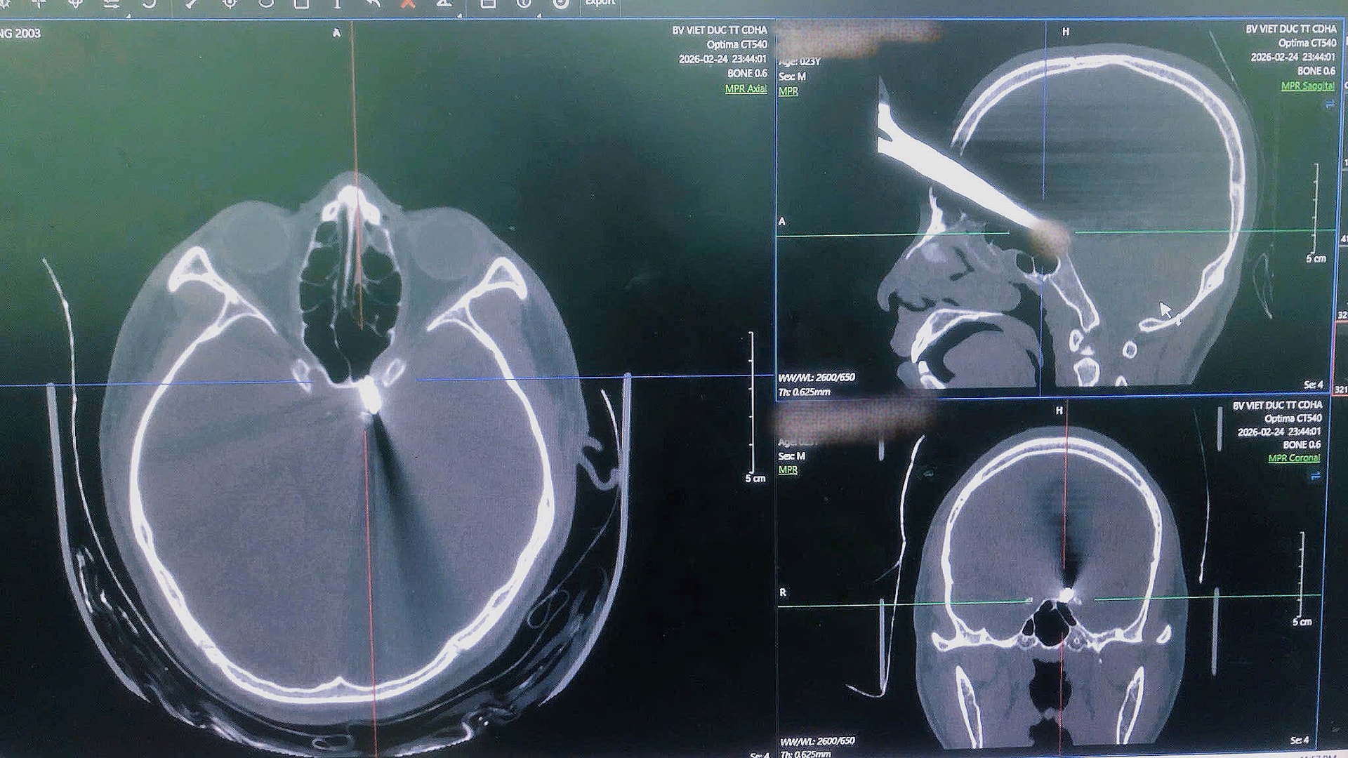 Hy hữu: Người bệnh nguy kịch do tự đâm kéo xuyên vùng đầu- Ảnh 1.