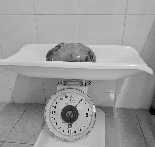 Người phụ nữ có khối u xơ tử cung to như quả bưởi- Ảnh 2.