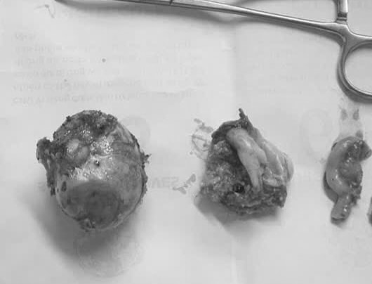 Người phụ nữ có 2 khối u quái hiếm gặp ở ổ bụng và buồng trứng- Ảnh 2.