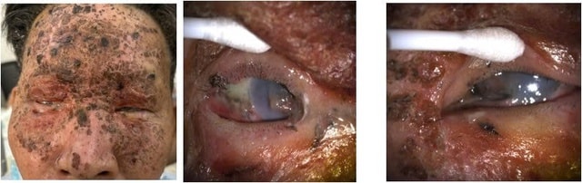 Nhiều ca tổn thương mắt nặng, nguy cơ mù lòa vĩnh viễn do nổ pháo- Ảnh 2. Nhiều ca tổn thương mắt nặng, nguy cơ mù lòa vĩnh viễn do nổ pháo- Ảnh 2.