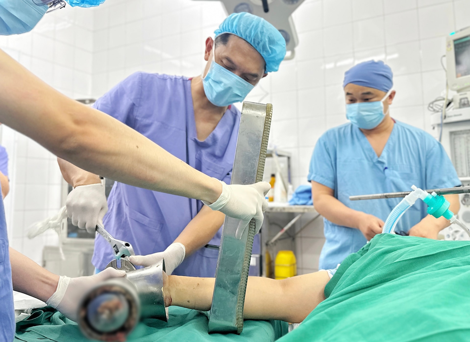 Người phụ nữ nhập viện với bàn tay vẫn còn kẹt nguyên trong máy xay thịt- Ảnh 2. Người phụ nữ nhập viện với bàn tay vẫn còn kẹt nguyên trong máy xay thịt- Ảnh 2.