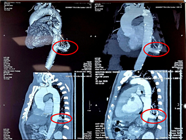 Bệnh viện Bình Dân phẫu thuật robot cắt phổi biệt lập, xử trí dị tật hiếm gặp trong lồng ngực- Ảnh 1. Bệnh viện Bình Dân phẫu thuật robot cắt phổi biệt lập, xử trí dị tật hiếm gặp trong lồng ngực- Ảnh 1.