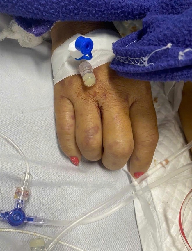 Chủ quan vì triệu chứng giống cúm, người phụ nữ nguy kịch do nhiễm não mô cầu- Ảnh 1.