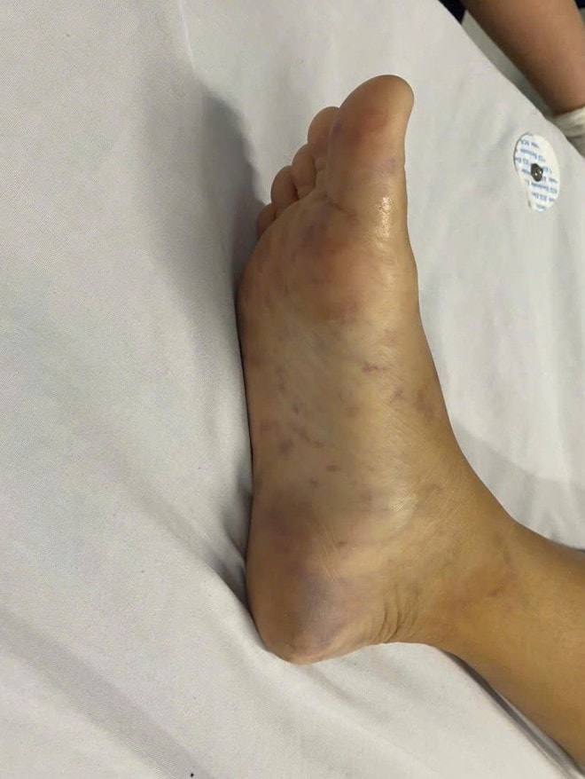 Chủ quan vì triệu chứng giống cúm, người phụ nữ nguy kịch do nhiễm não mô cầu- Ảnh 2.